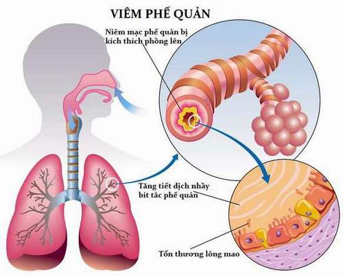bệnh viêm phế quản cấp là căn bệnh về hô hấp thường gặp nhất ở Việt Nam
